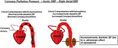 Epinephrine Use during Newborn Resuscitation